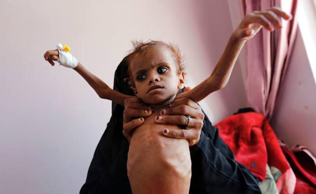 Una mujer sostiene a su hija mientras esta recibe asistencia en la unidad de urgencias de un centro de tratamiento de malnutrición en Saná (Yemen).