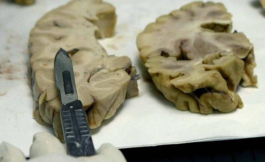 Donación de cerebros en la Fundación CIEN (Centro de Investigación de Enfermedades Neurológicas). 