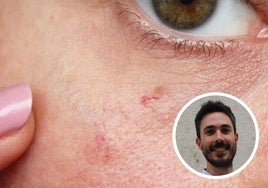 Imagen de la piel del rostro con manchas. En el círculo el experto en dermocosmética Alberto León.
