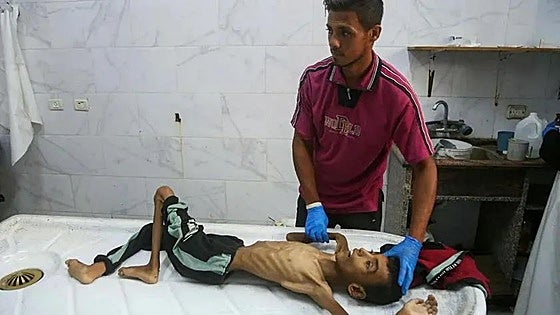 Un hospital de Gaza anuncia que 21 niños murieron de malnutrición y hambre en 72 horas