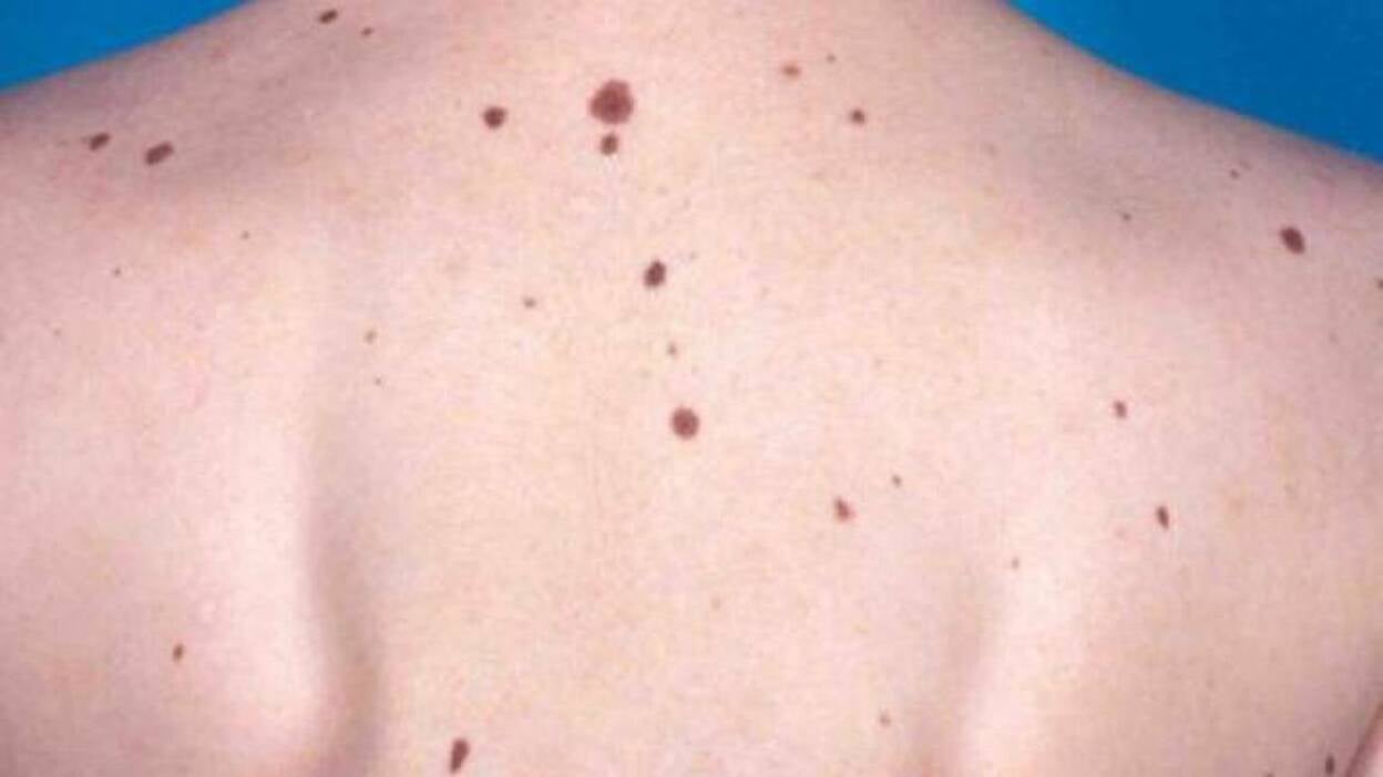 Melanoma: un cáncer de jóvenes