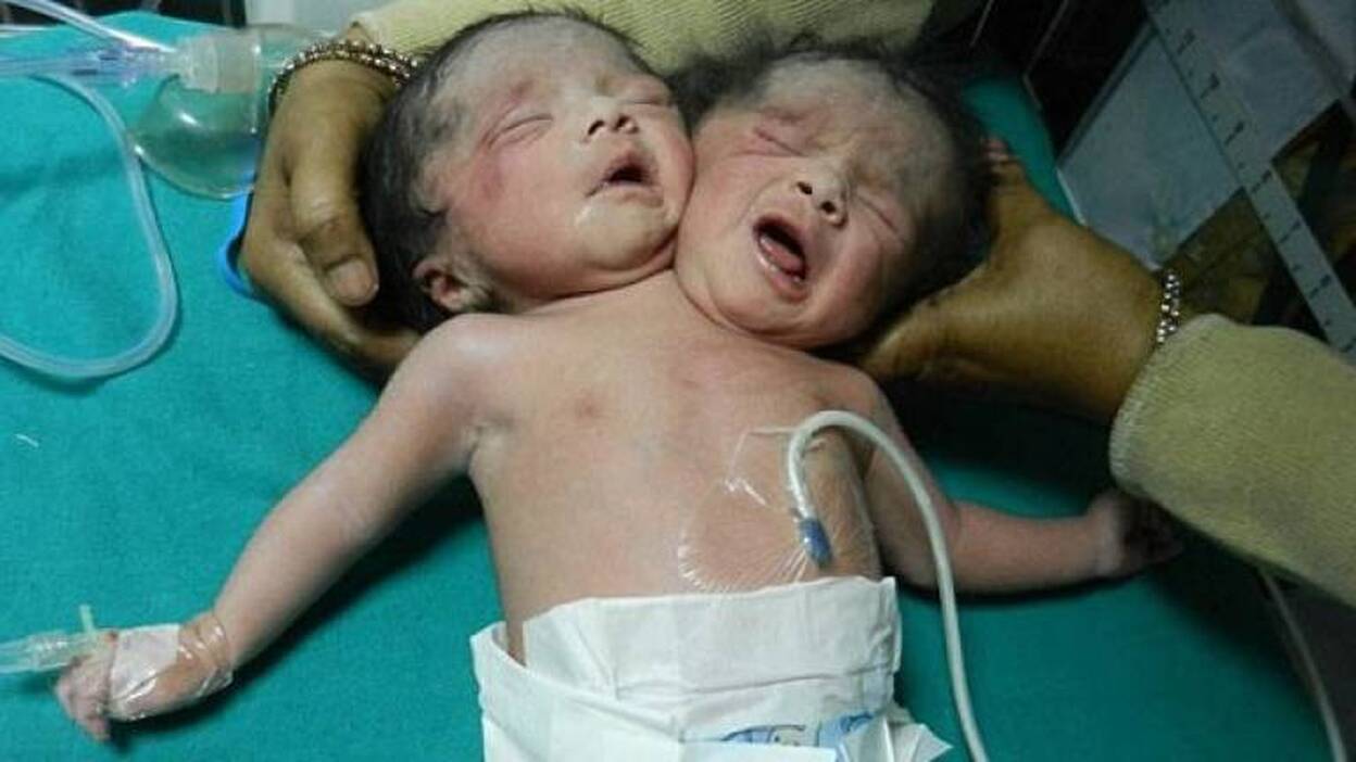Nacen siamesas con un único cuerpo en Bangladesh