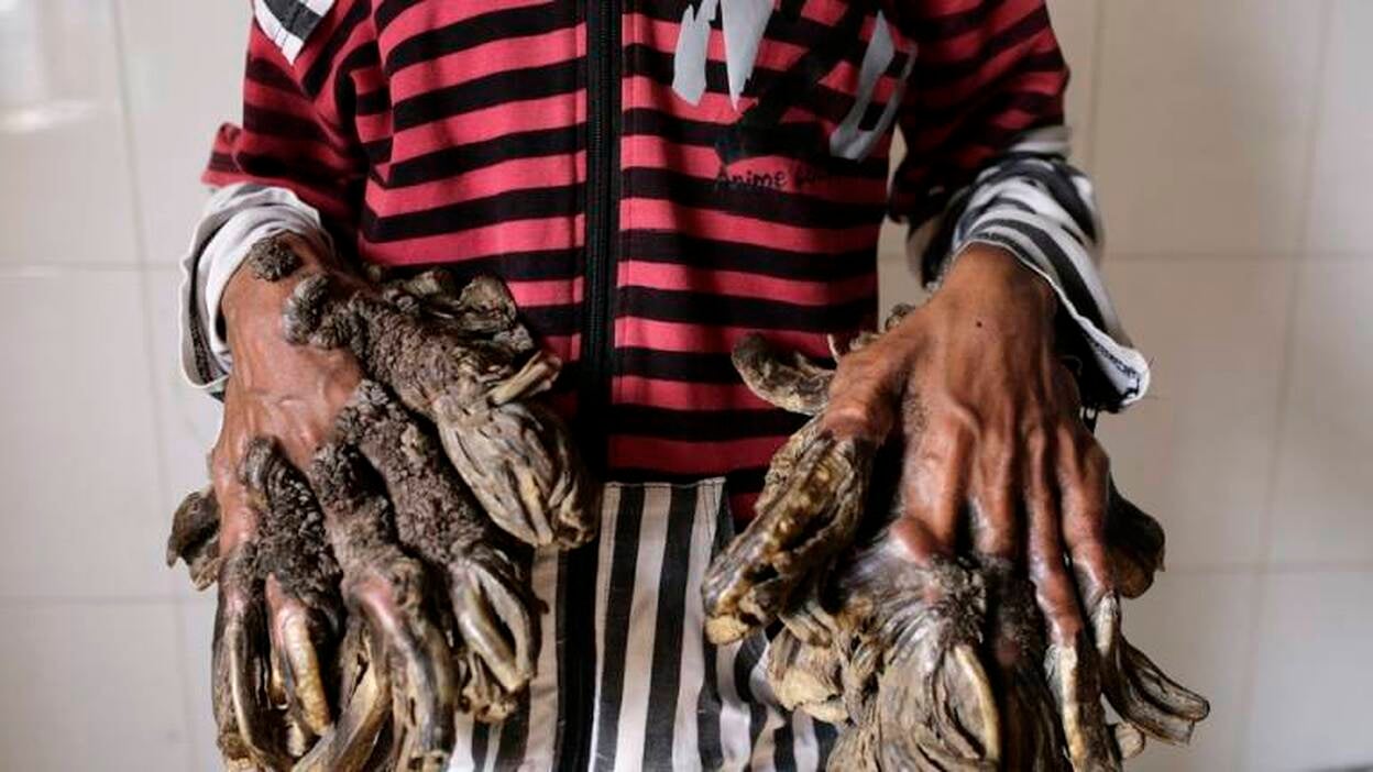 Todo preparado para operar al "hombre árbol"