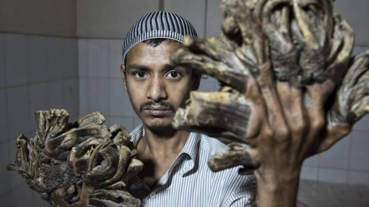 El "hombre árbol" de Bangladesh supera con éxito su primera operación