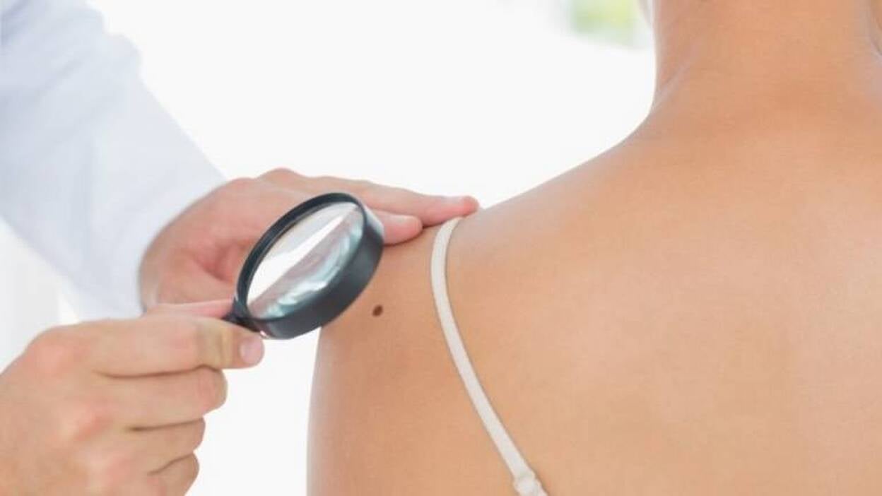 La tasa de mortalidad por melanoma se ha estabilizado en España