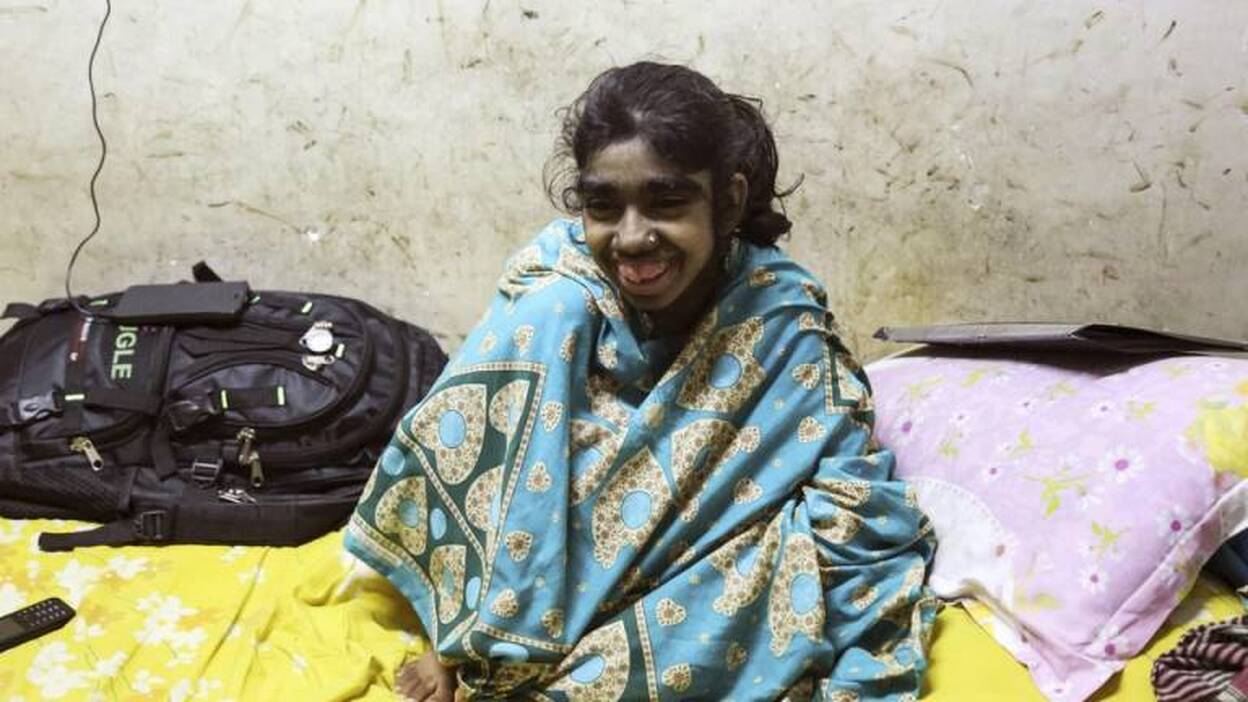 La ciencia, última esperanza para la "niña lobo" de Bangladesh