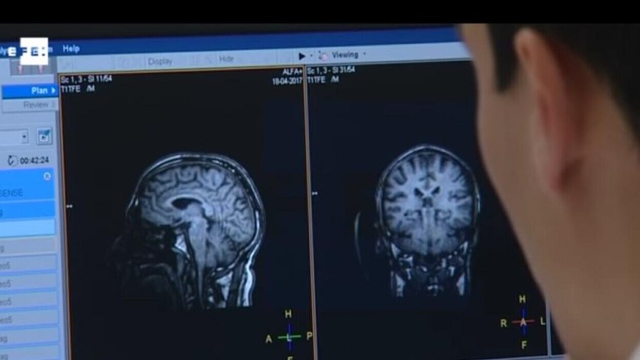La neuroimagen puede predecir el alzhéimer con 15 años de antelación