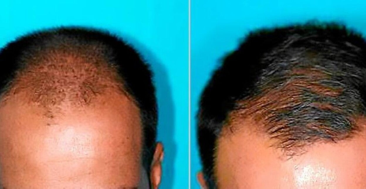 El trasplante de pelo no es la única solución para la calvicie