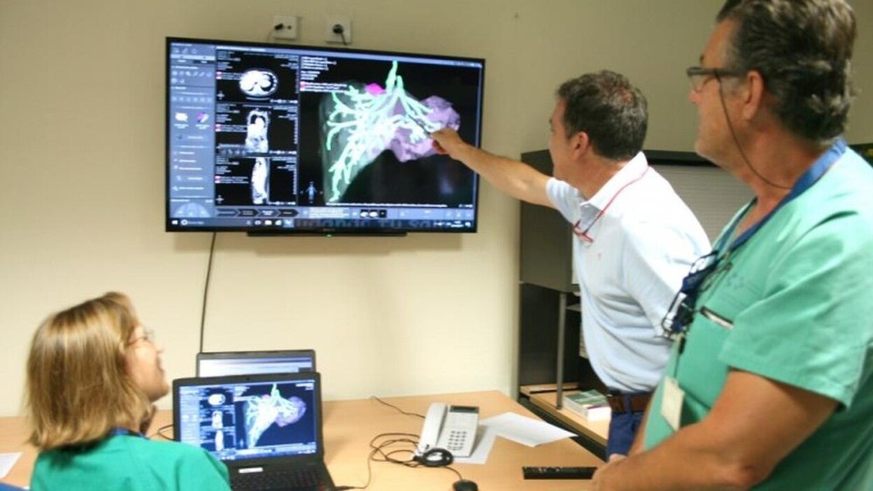 Reproducciones en 3D para lesiones hepáticas en La Candelaria