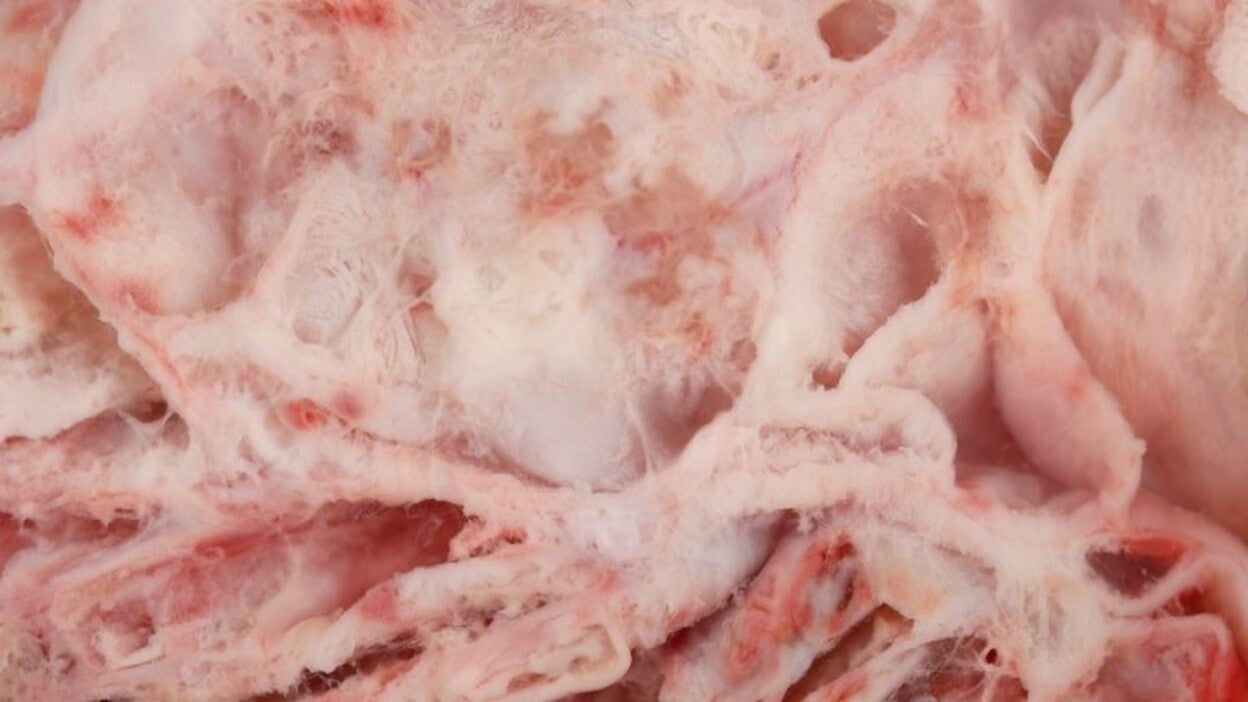 Logran frenar la progresión del cáncer de ovario recurrente