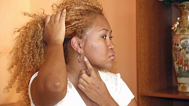 Ketty muestra el rastro de la cuchillada que estuvo a punto de provocarle parálisis en toda la cara según los forenses.