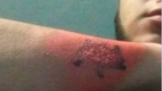 Se borra un tatuaje con un rallador de queso