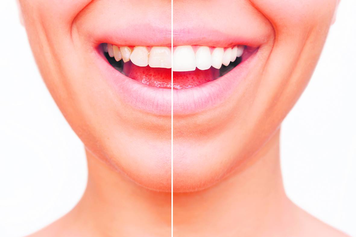 Las carillas ponen orden en el caos y una solución perfecta y menos invasiva que otros tratamientos cosméticos.