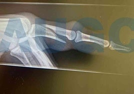 Imagen de la radiografía de la fractura del agente de la Guardia Civil.