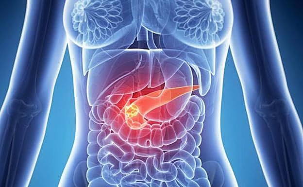 Los cuatro síntomas que notarás en tu cuerpo si tienes cáncer de páncreas