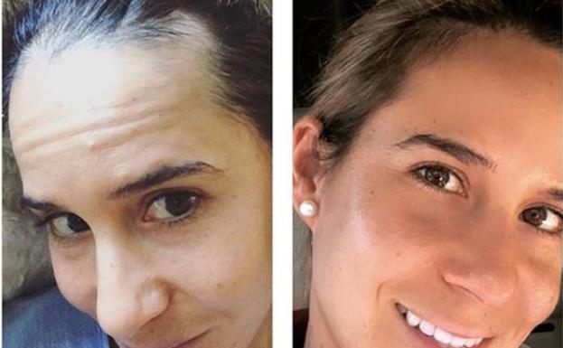 Azahara muestra en su Instagram cómo llegó a perder mucho pelo; la segunda foto, de hoy, con la malagueña mucho mejor tras iniciar un tratamiento 