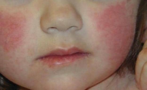 Virus del del niño abofeteado o quinta enfermedad: causas, síntomas precauciones a en cuenta | Diario Sur
