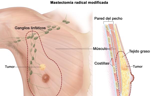 Mastectomía radical modificada.