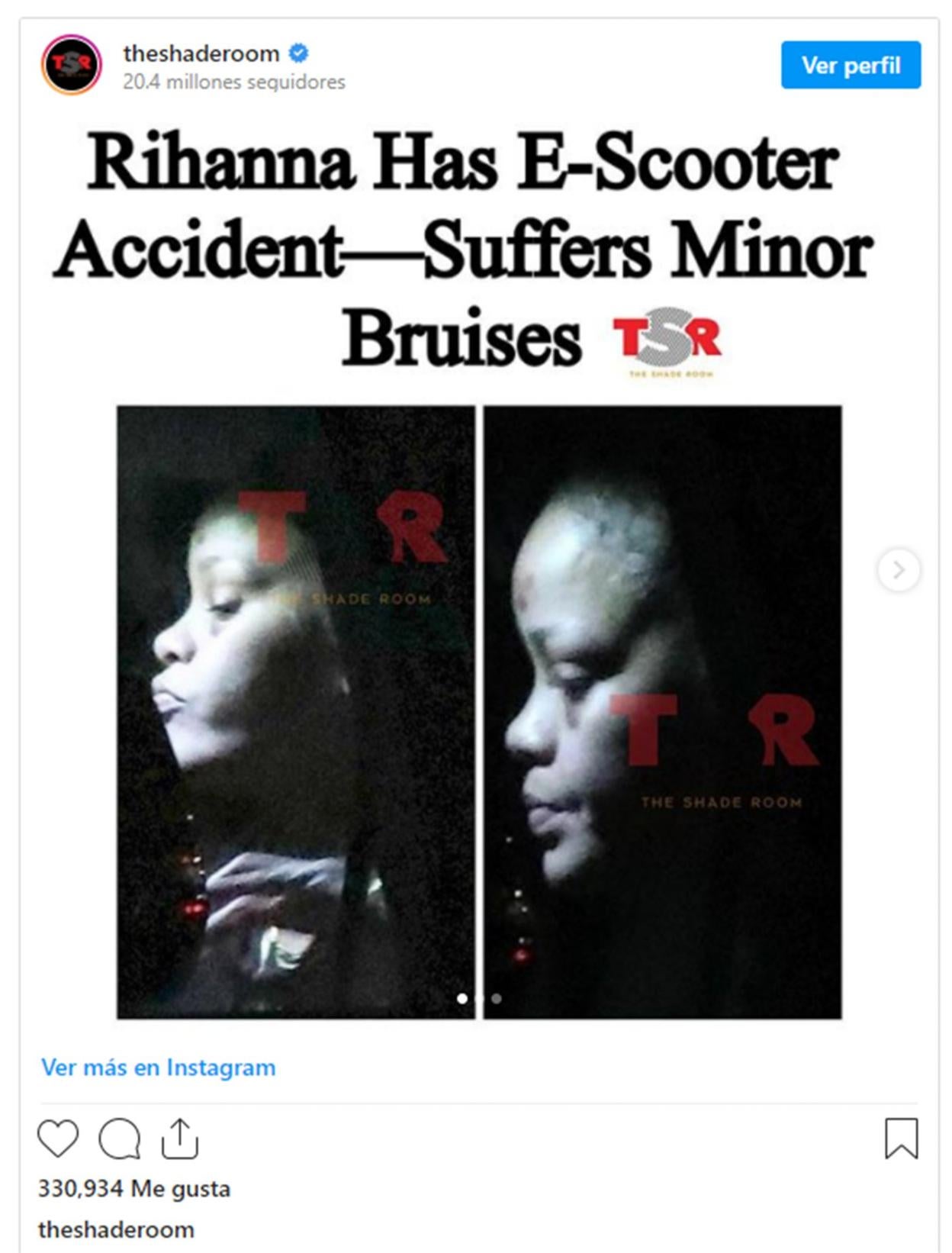 Imagen de Instagram donde Rihanna muestra las secuelas del accidente. 