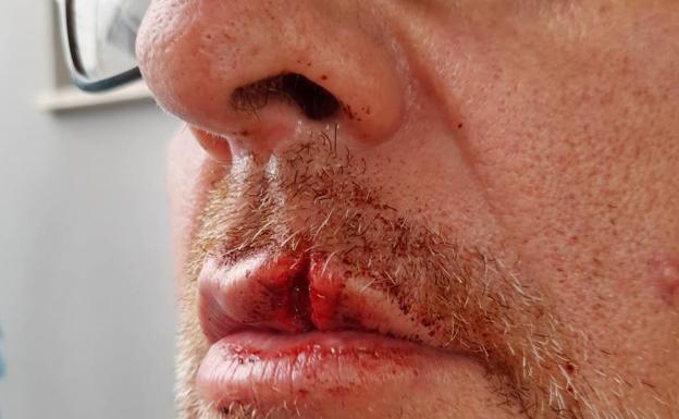 El puñetazo le ocasionó un corte bastante profundo en el labio. 