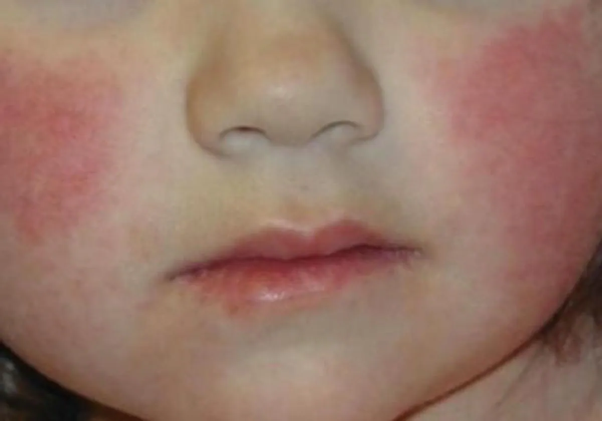 Los niños presentan un enrojecimiento de las mejillas con la enfermedad.