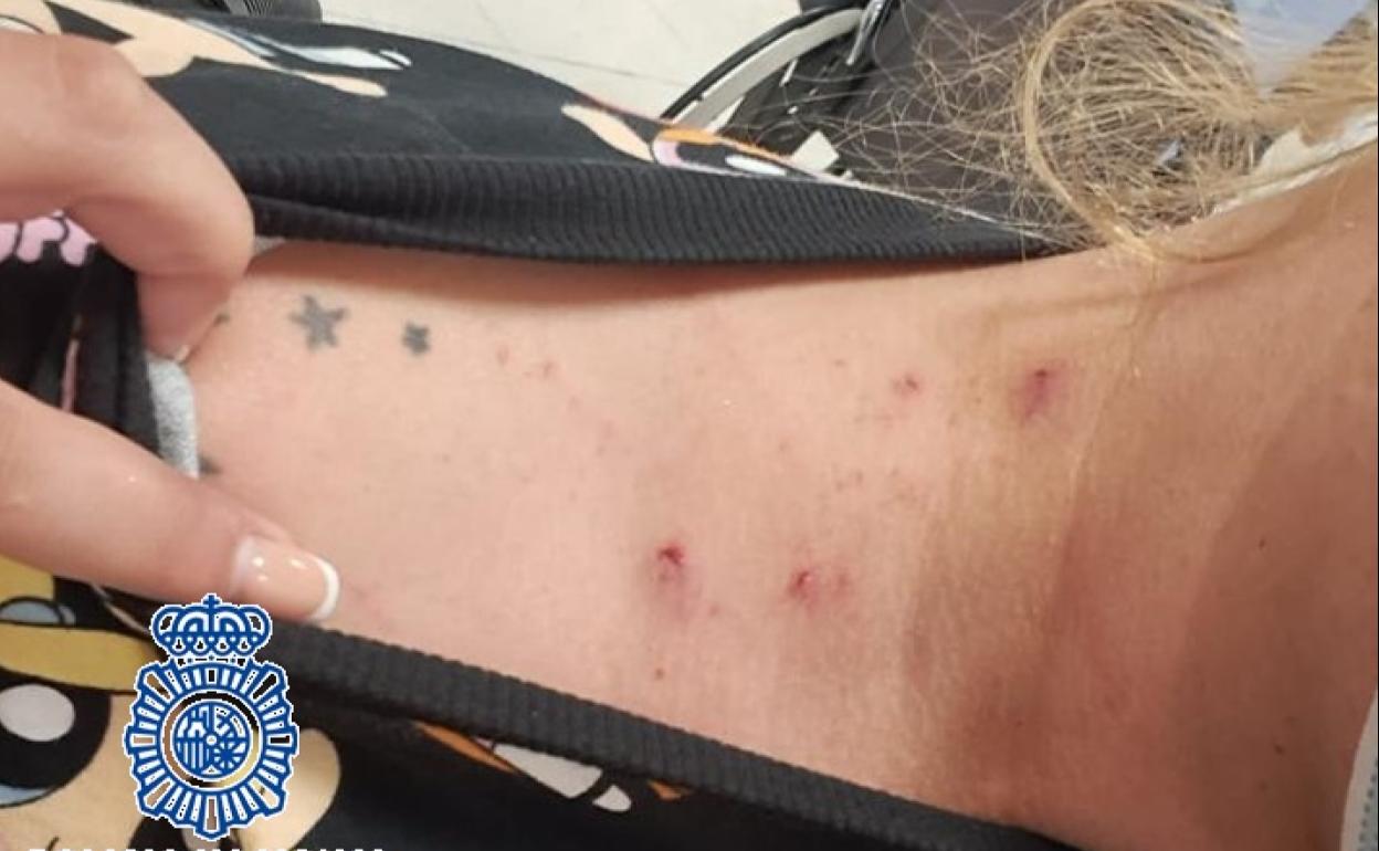 Heridas que presentaba en el cuello una de las mujeres. 