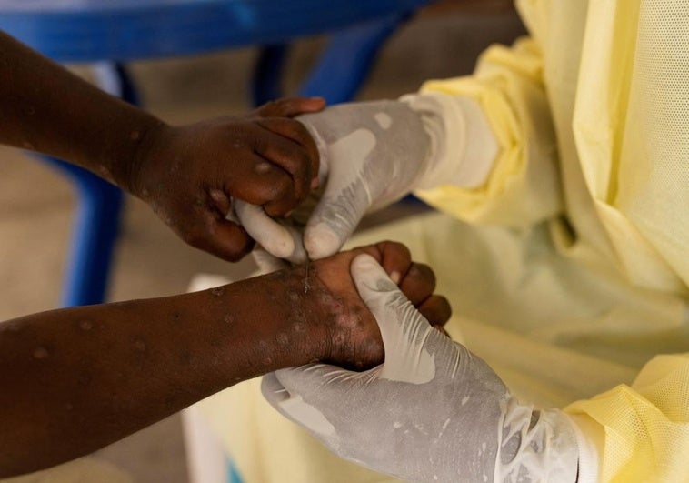 Un enfermero toma muestra de un niño con Mpox.