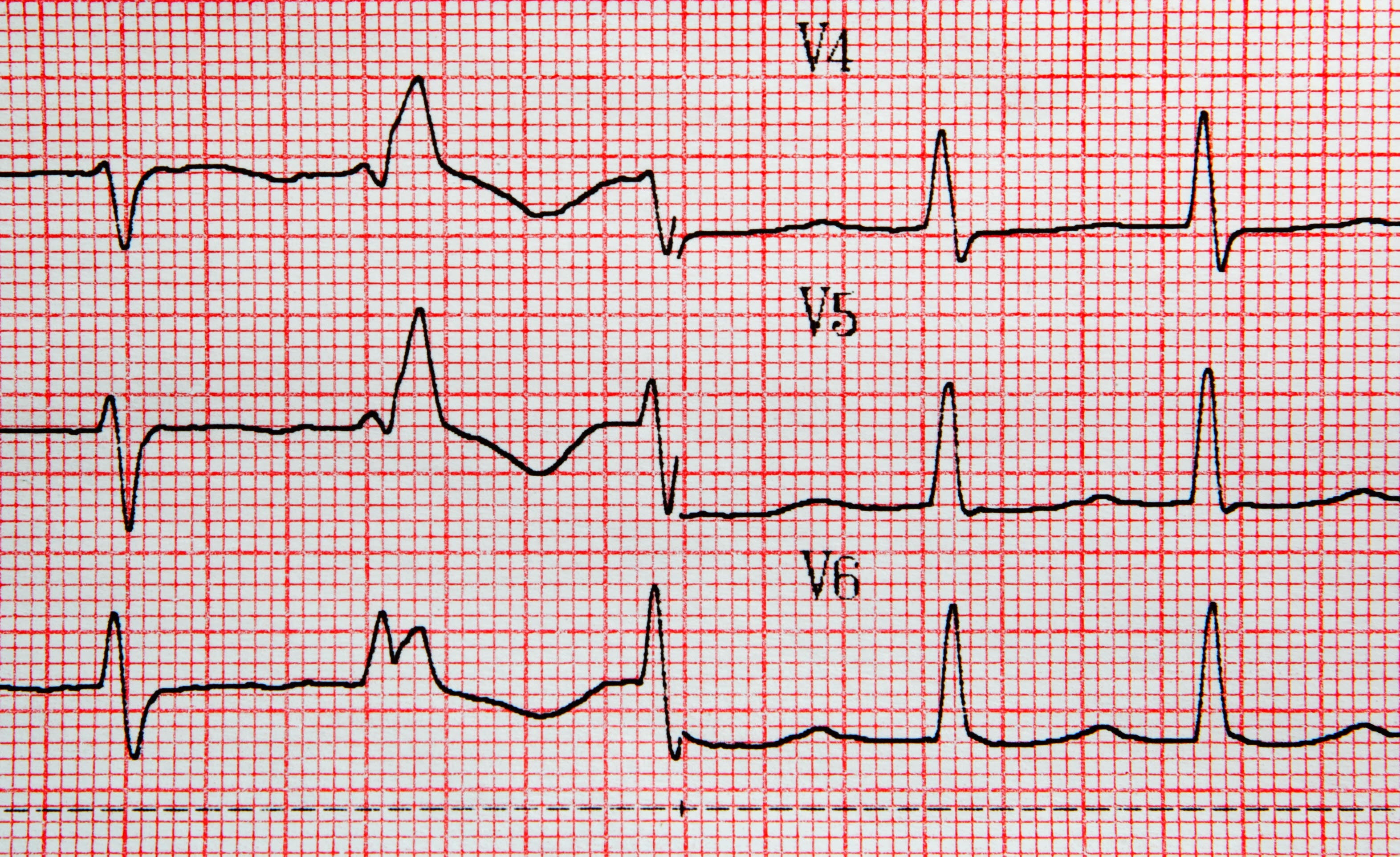¿Es efectiva la ablación de la fibrilación auricular?