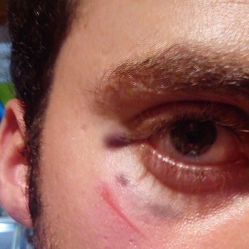 El ataque le dejó un moratón en el ojo derecho.