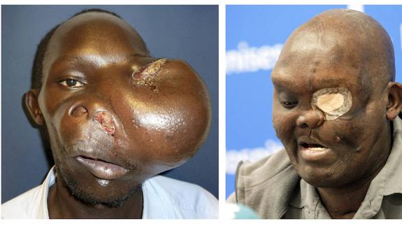 Mike Koech, con el rostro deformado por un tumor incontenible. A la derecha, ayer en Valencia tras ser operado por Cavadas. 