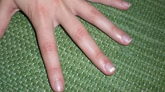 Imagen de un dedo de una mano con una mancha blanca. 