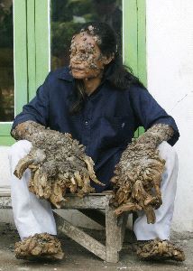 La extraña enfermedad del 'hombre árbol' de Indonesia