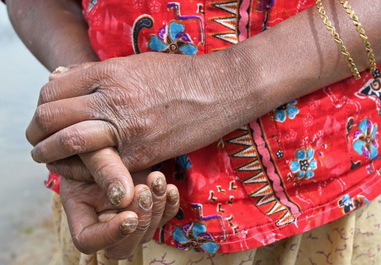 Casi medio millón de personas de esta etnia musulmana han huido de Birmania a Bangladesh. Escapan de la violencia y la represión a la que les someten las fuerzas del estado birmano, a raíz de un ataque perpetrado por un grupo insurgente el 25 de agosto. Tras cruzar la frontera, se alojan en campos de refugiados; más de 600.000 son niños