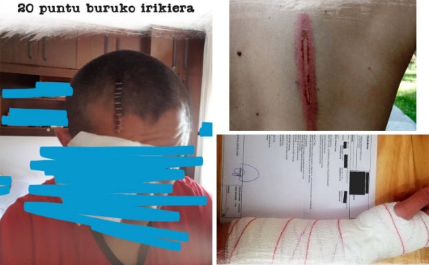 Muñecas rotas, 20 puntos de sutura en la cabeza... las agresiones que denuncia Bultzada por parte de la Policía Nacional