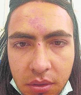 Imagen secundaria 2 - Moratones y una nariz, una cara y una muñeca rotas . El puñetazo que recibió Carla le ha dejado como marca un moratón en el ojo. También presenta hematomas y cortes Yeisson. Peor parado salió Brayan, con la nariz, la cara y una muñeca rota. 