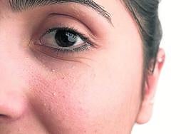 Las bolitas blancas se diferencian de otras afecciones por su dureza.