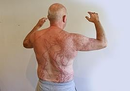 Javier muestra las numerosas marcas en la espalda, axilas, piernas y brazo derecho provocadas por una picadura de 'carabela portuguesa' el pasado martes en Ondarreta. Los socorristas proceden a retirarlelos tentáculos de las zonasafectadas.