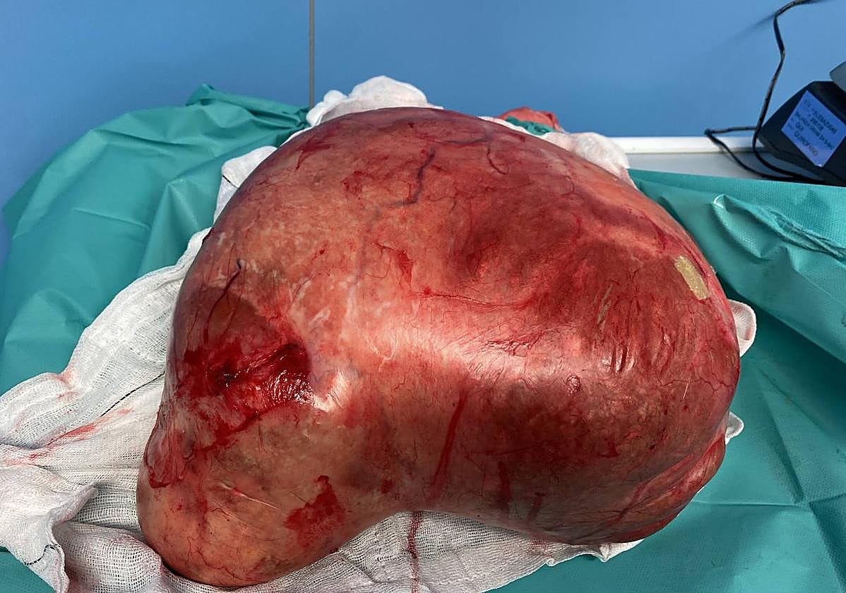 Imagen del quiste ovárico extirpado a una guipuzcoana de 63 años.