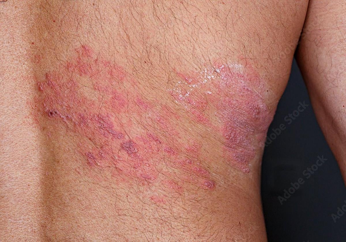 Ampollas en la piel provocadas por el herpes zóster, una enfermedad dolorosa causada por el virus de la varicela que está en aumento en Euskadi.