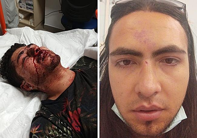 Brayan (izquierda) y Yeisson (derecha), tras la paliza.