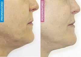 Antes y después de una paciente de lifting cervicofacial