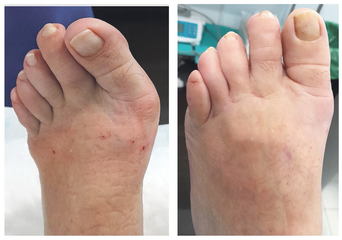 Antes y después de una cirugía de mínima incisión de juanete.