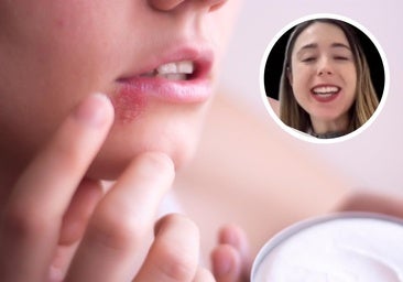Una dermatóloga vasca alerta sobre los remedios caseros para tratar el herpes: «Pueden aumentar la inflamación y dejar marca»