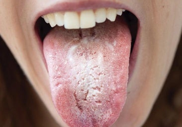 No más candidiasis: alimentos para combatirla