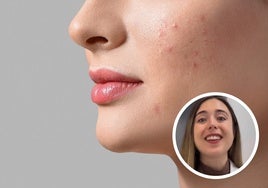 Una dermatóloga vasca explica los tres errores al tratar el acné: «Lo primero a evitar es tomar proteína derivada de la leche de vaca»
