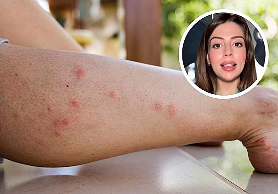 La explicación científica que aclara por qué hay personas que sufren más las picaduras de mosquitos: «Sudan y tienen más papeletas»