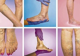 Últimas novedades contra las varices