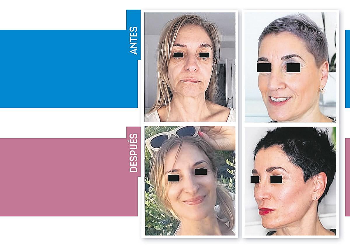 Rejuvenecimiento facial