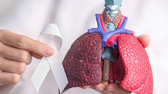 El cribado con TAC de baja dosis y los nuevos tratamientos podrían cambiar el pronóstico del cáncer de pulmón