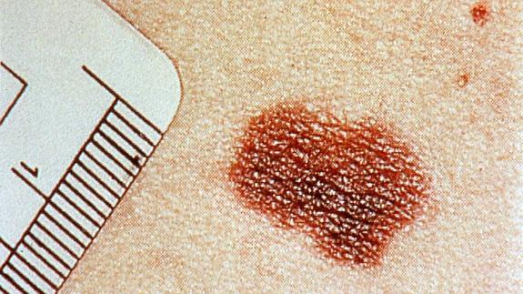 La incidencia de melanoma se ha multiplicado por mil en 20 años